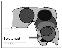Stretched Colon