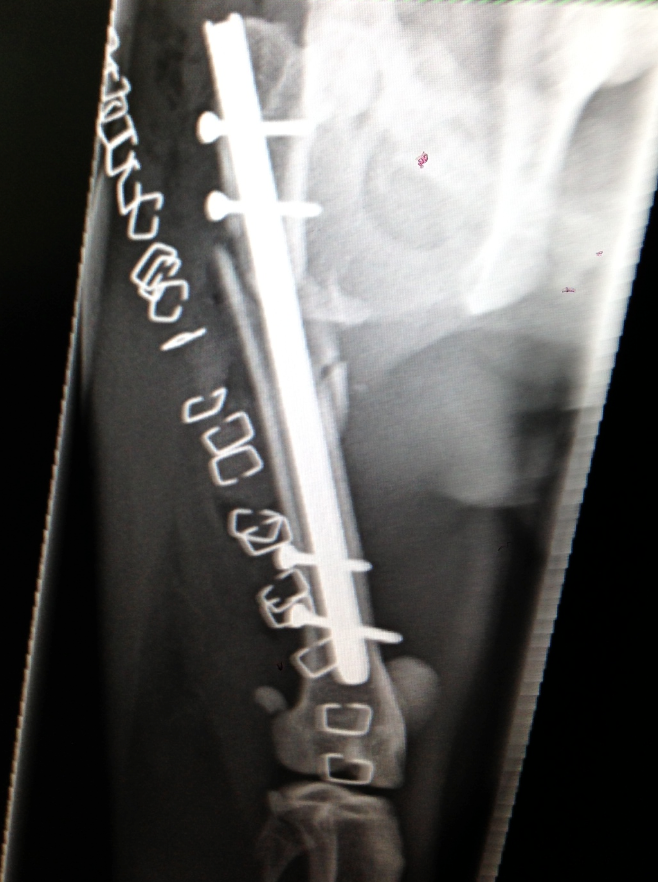 screen-shot-2013-05-20-at-104218-am.png X-ray of a leg with a metal rod and screws inserted for bone stabilization, possibly after a fracture.