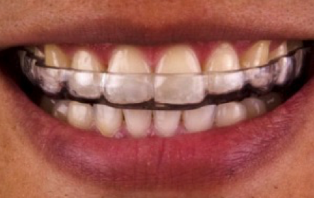 A Close Up of a Person's Teeth With Clear Braces — New Leaf Dentists in Erina, NSW