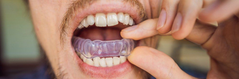 Living With Invisalign Day To Day