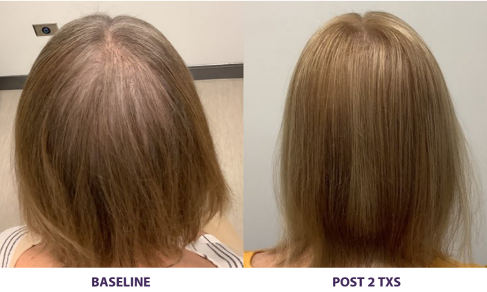 Before-and-after scalp photos showing hair thinning at baseline and fuller hair after 2 treatments
