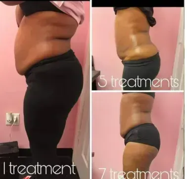A comparison collage showing side profiles of a midsection after 1, 5, and 7 body contouring treatments against a pink wall.