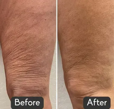 A side-by-side comparison showing skin texture improvement on a thigh, with the "after" image appearing smoother.