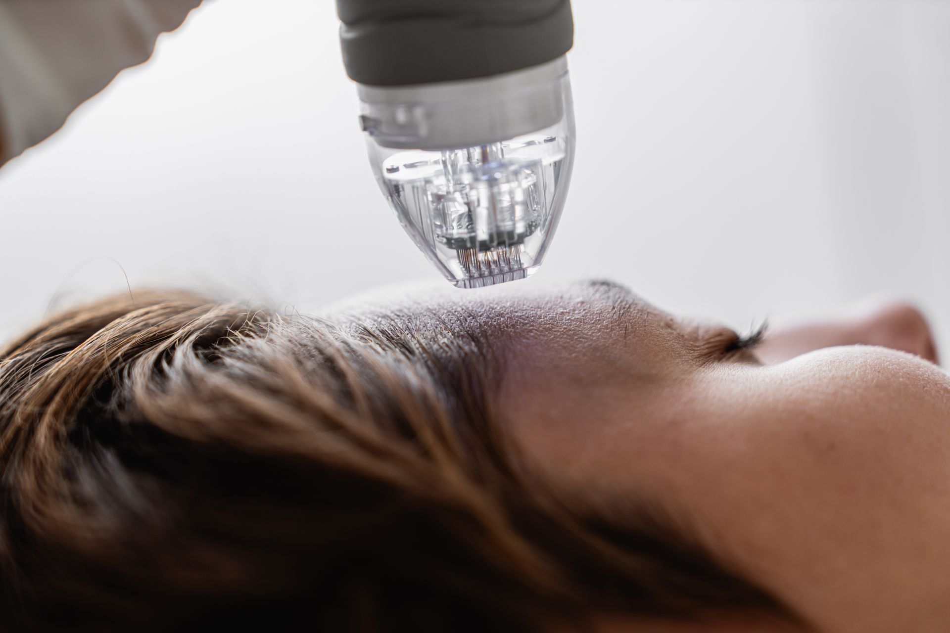 A professional cosmetic device with a needle tip is positioned above a person's forehead for a microneedling treatment.