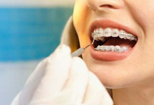 apparecchio ortodontico su arcata inferiore e superiore
