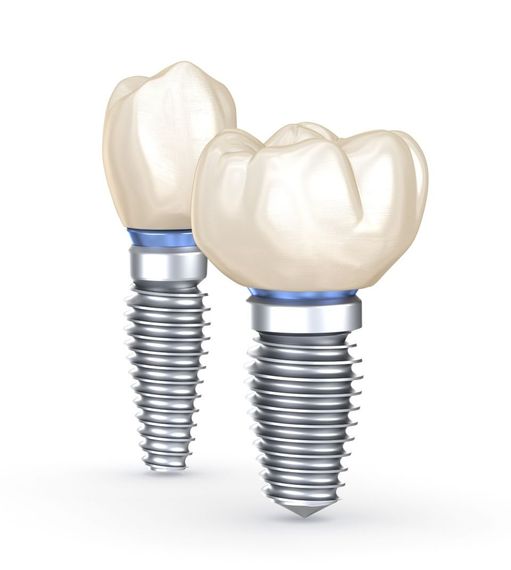 implantologia dentale a Roma