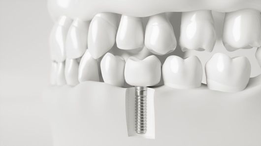 implantologia dentale Roma