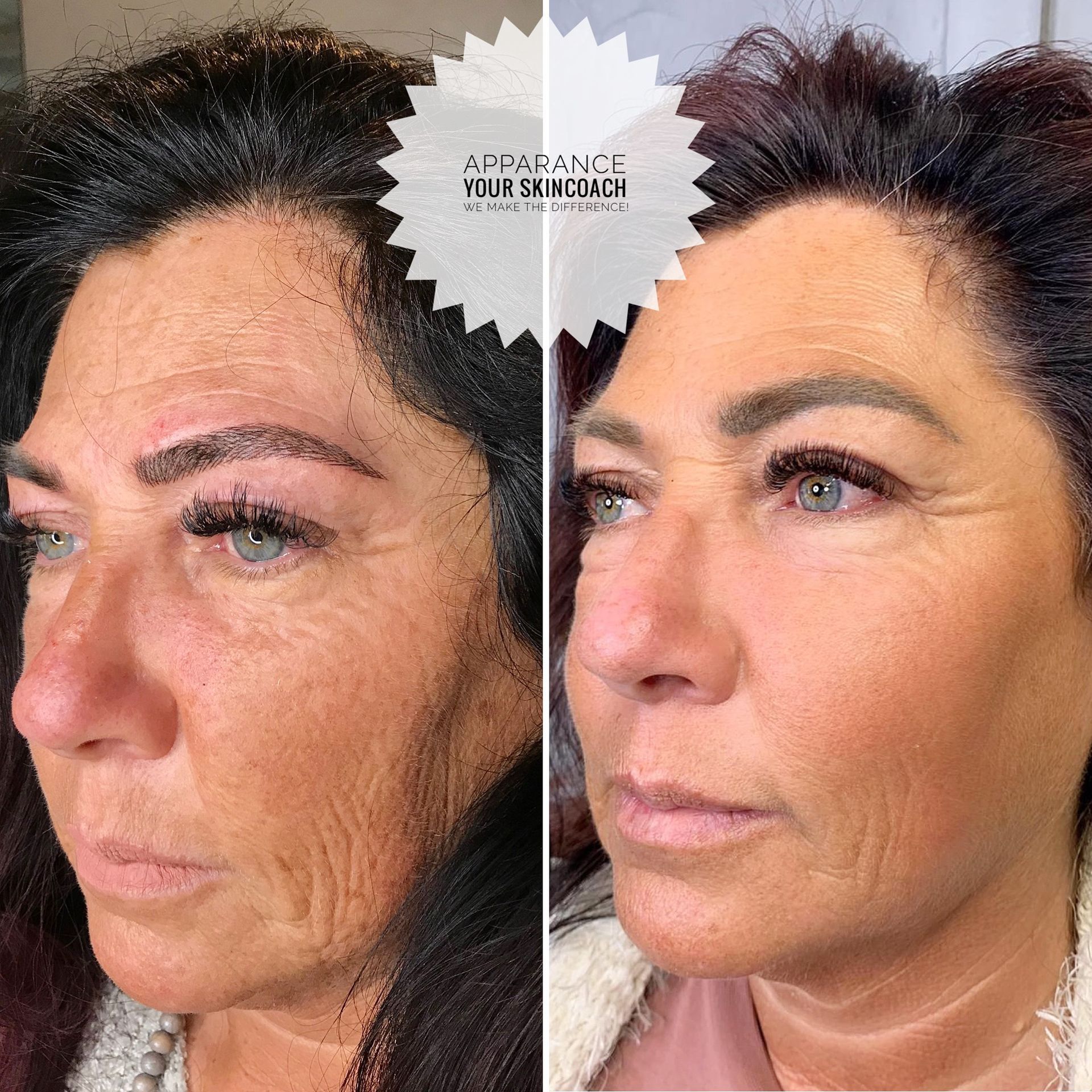 huidverbetering rimpels versteviging botox fillers dermapen schoonheidssalon gezichtsbehandeling apparance