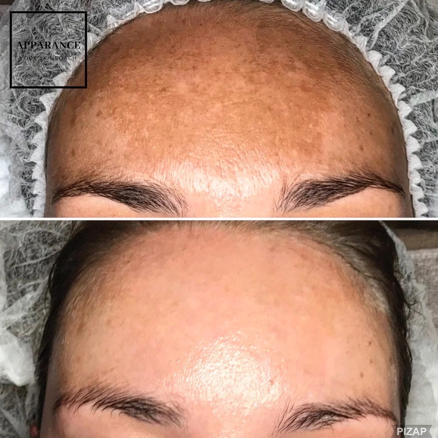 Meline pigmentbehandeling pigmentvlekken weghalen zonder laseren ouderdomsvlekken huidspecialist schoonheidssalon  