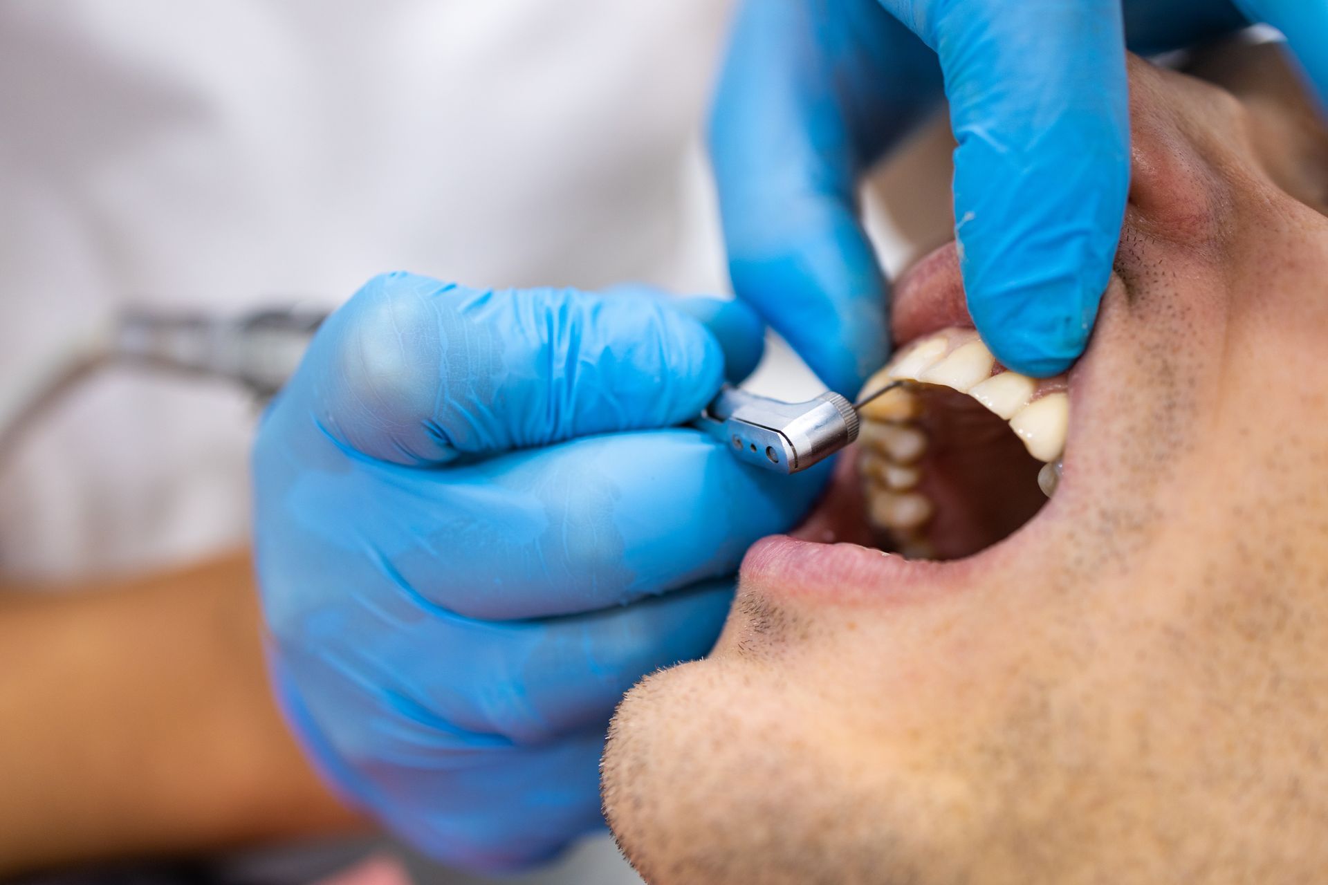 Gloved dentist using a drill on a patient's open mouth during a dental procedure