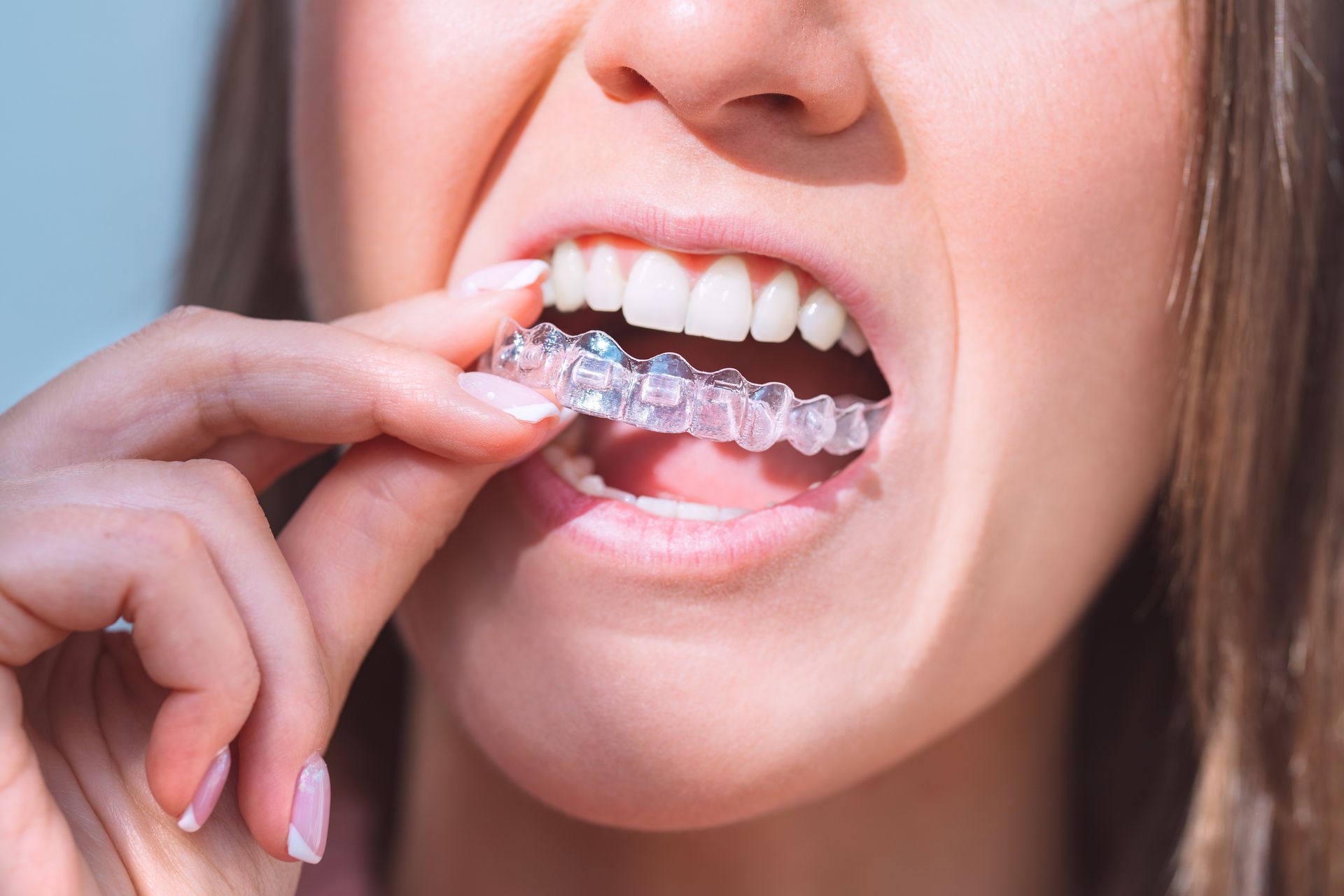 Close-up of a person inserting a clear dental aligner over their teeth