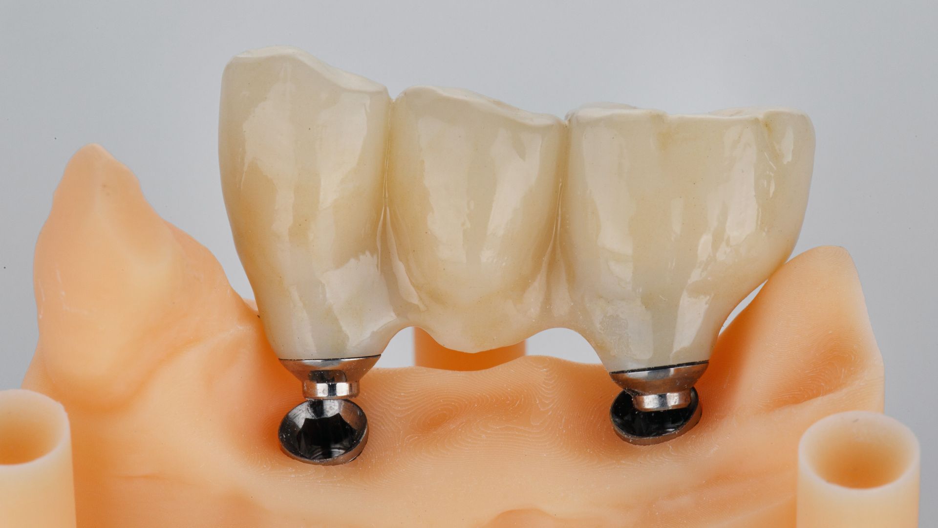 Dental prosthesis with two metal implants on a gum-colored model