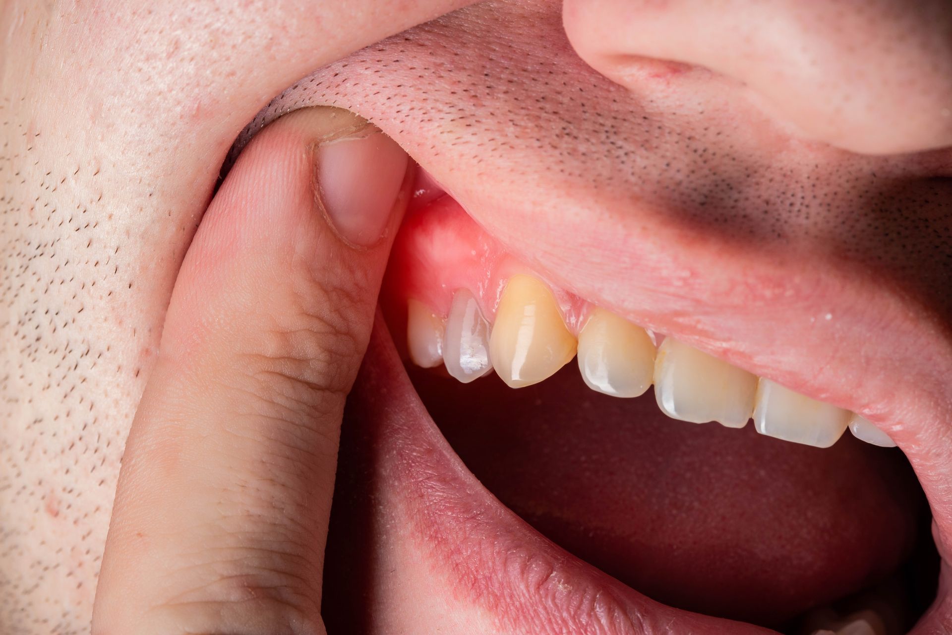 Hand holding cheek beside a red, swollen gum near an upper tooth