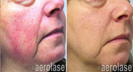 Before and after photos of woman's face, showing reduction of redness on left cheek after laser treatment.