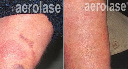 Before and after photos of a woman's chin and jawline. The 