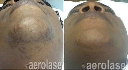 Before-and-after showing facial hair reduction in dark-skinned person's chin. The 