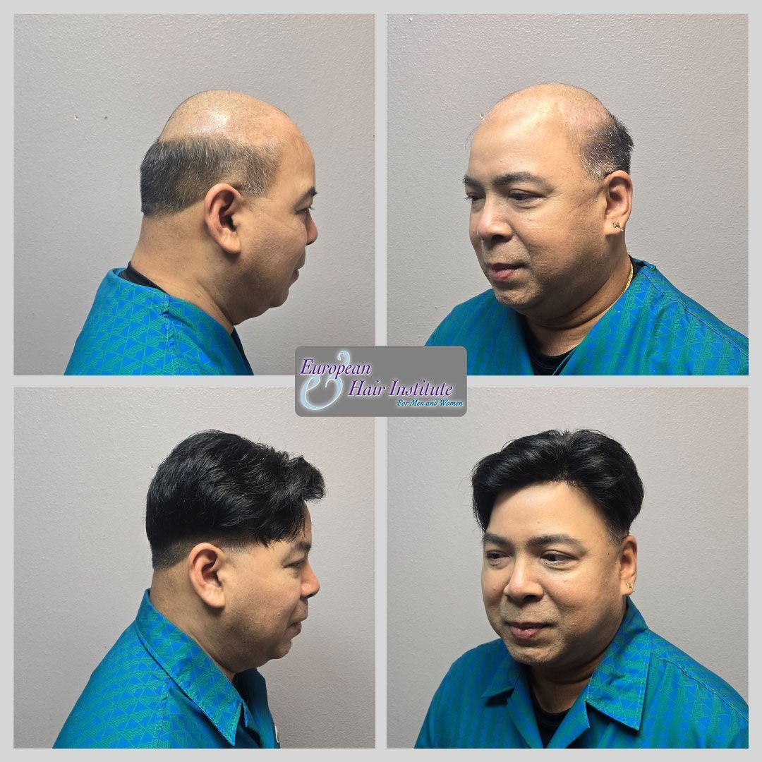 Men's hair replacement systems before and after image.