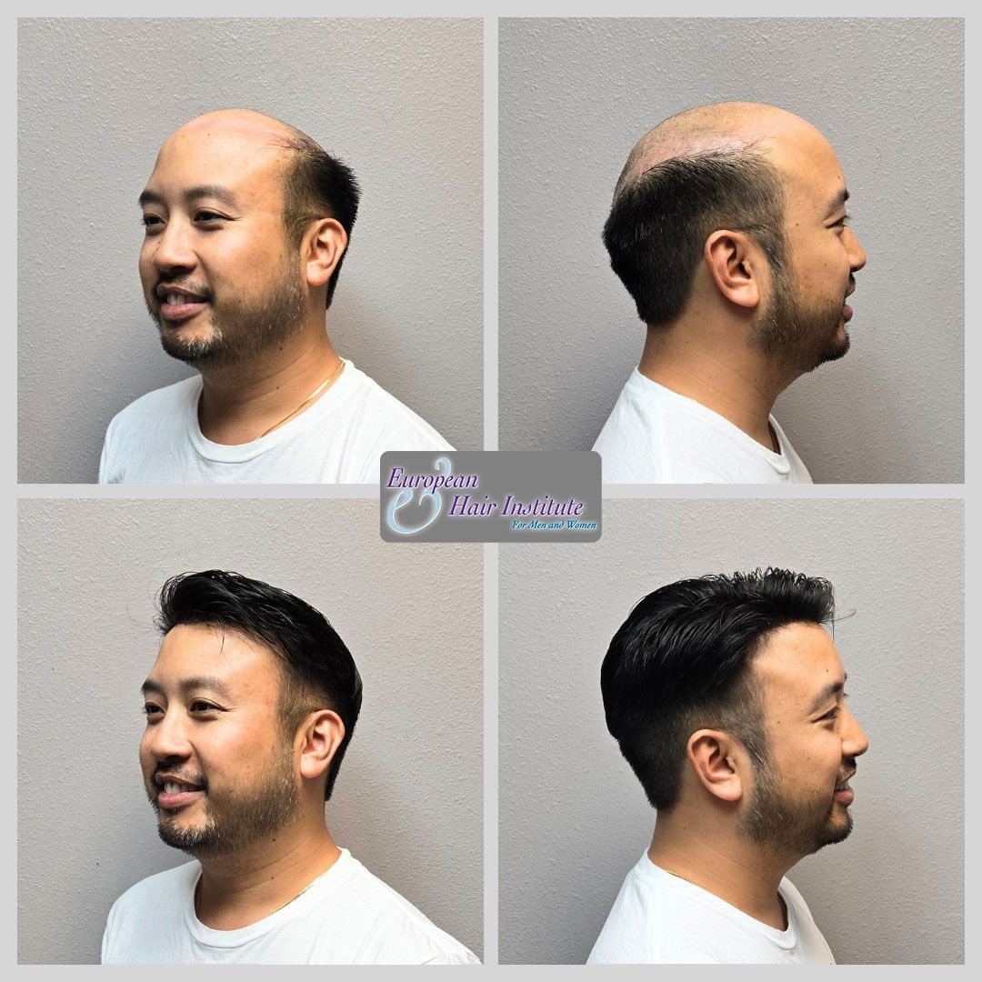 Men's hair replacement systems before and after image.