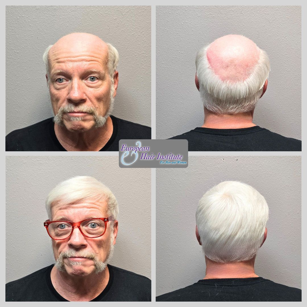 Men's hair replacement systems before and after image.
