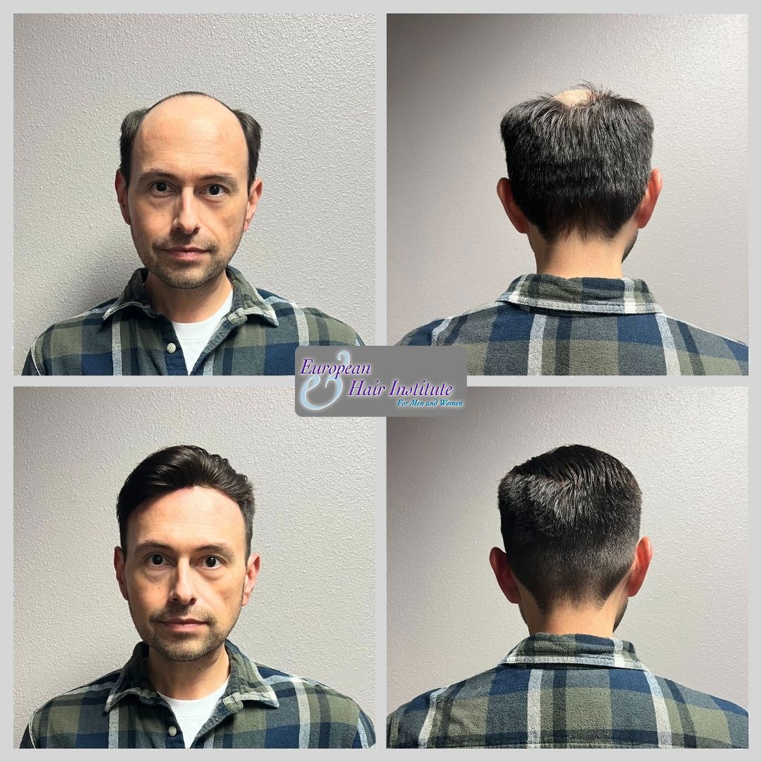 Men's hair replacement systems before and after image.