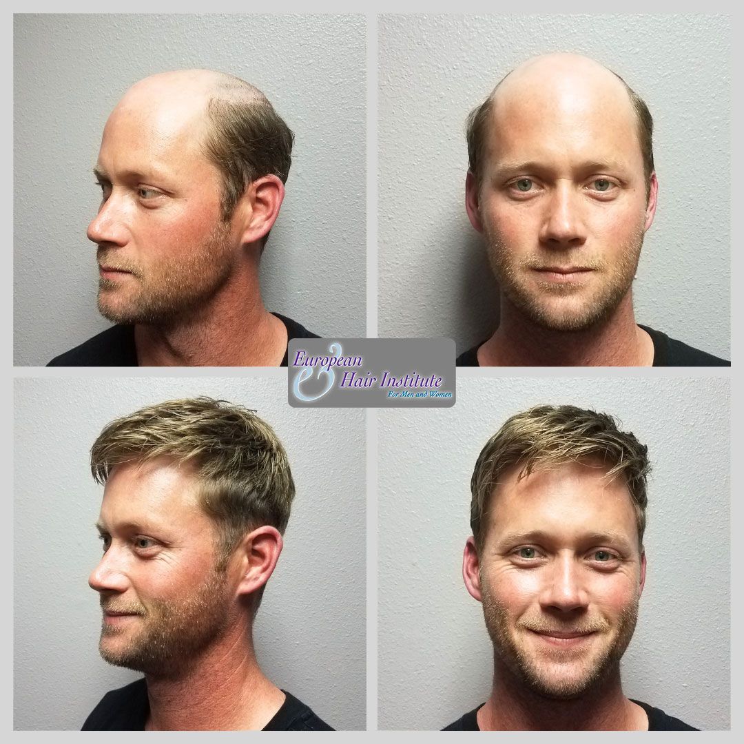Men's hair replacement systems before and after image.