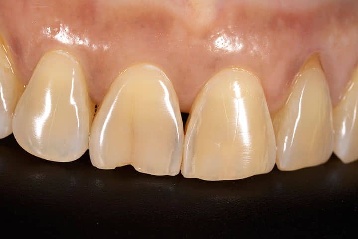 Dientes fracturados