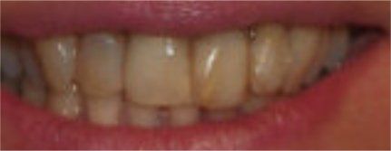 Before Teeth Cleaning