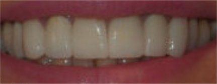 After Teeth Cleaning