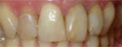 Before VELscope Vx Treatment