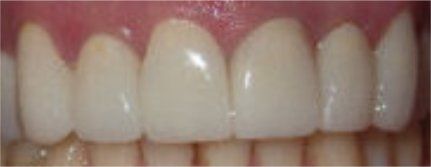 After VELscope Vx Treatment