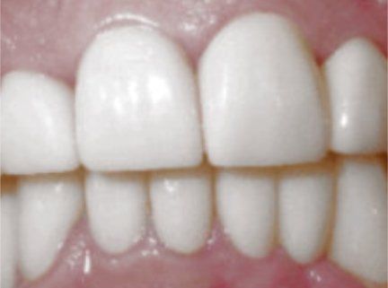 After Dental Implants