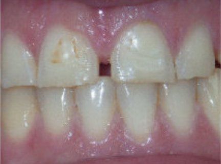 Teeth Whitening Before