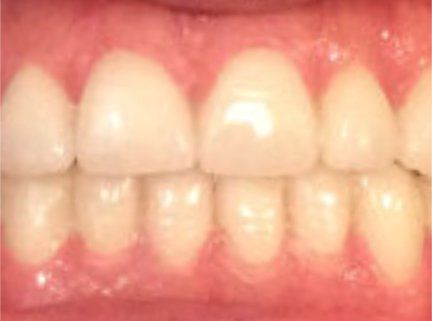 Teeth Whitening After