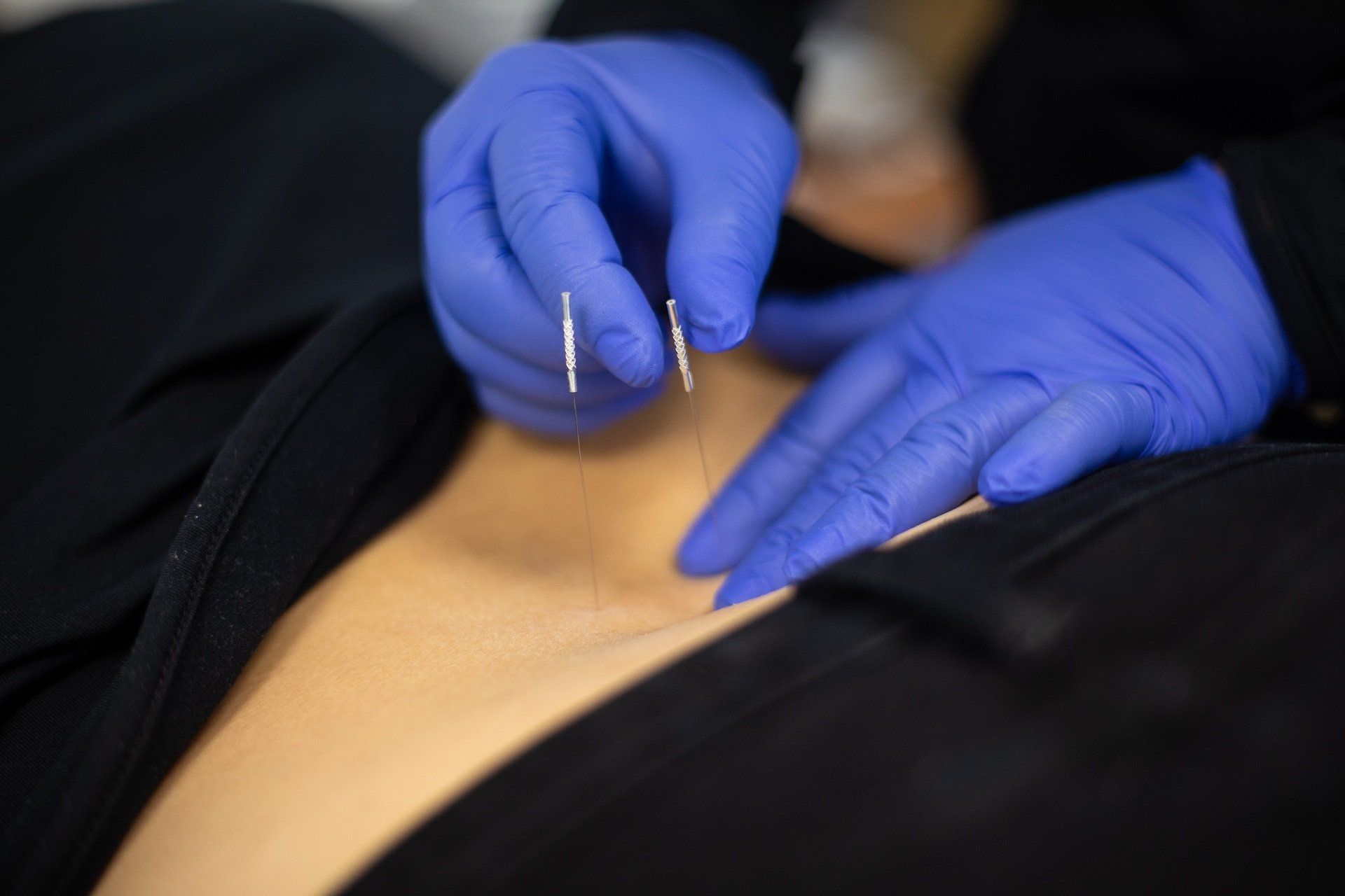 spinal cord stimulator battery replacement cost