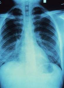 Using a Vocational Expert in a Spinal Cord Injury Case