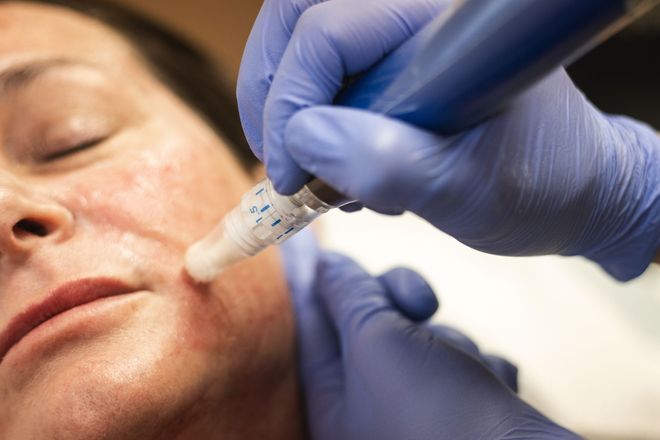 Gloved hands inject filler into a woman’s cheek with a syringe during a cosmetic procedure
