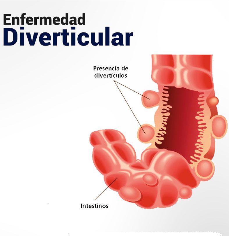 Tratamiento a hemorroides