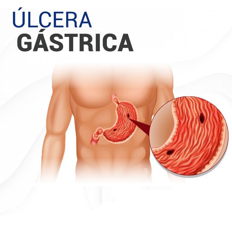 Úlcera gástrica