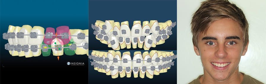 Orthodontic Treatment Orthodontic Treatment