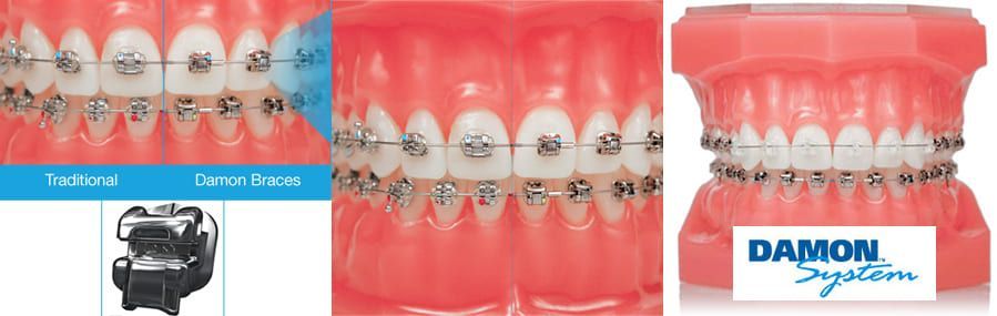 Damon System Compared To Traditional Braces Damon System Compared To Traditional Braces