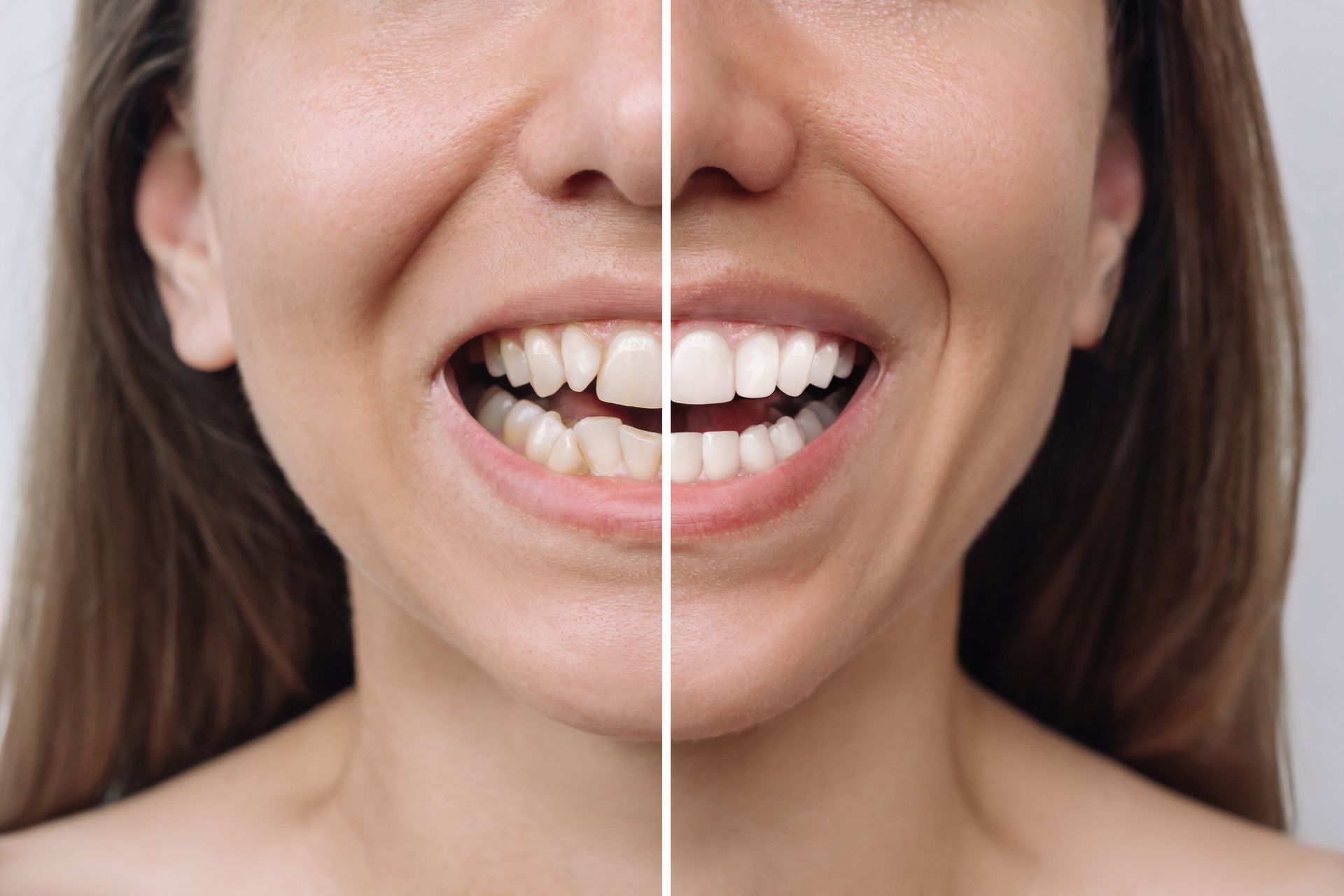 Before & After Image Woman's Teeth
