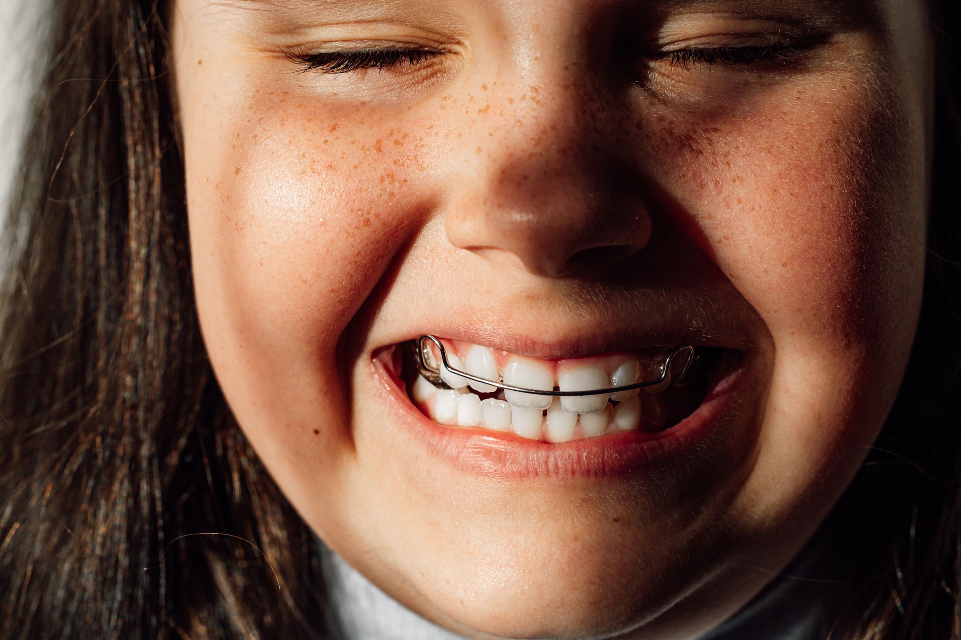 Braces Treatment