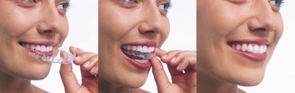 Invisalign Clear Aligners Invisalign Clear Aligners