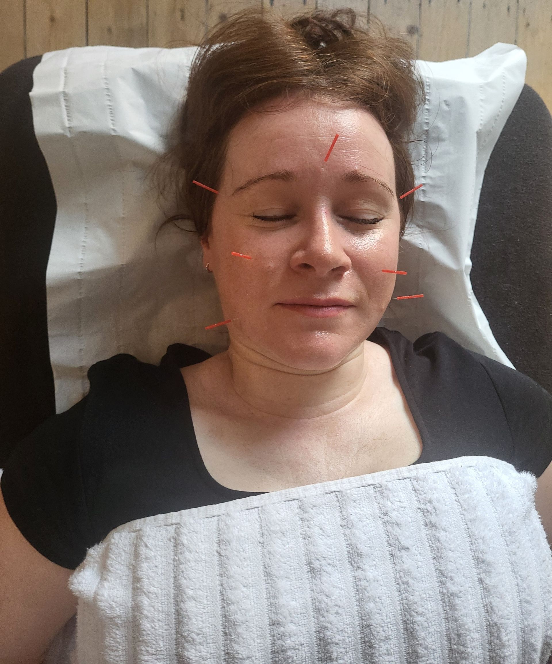 Woman receiving facial acupuncture, lying on a table with needles inserted in her face, covered by a towel.