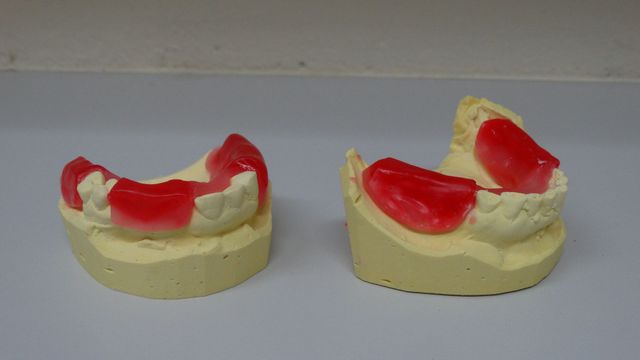 Partial Wax Bite — Batehaven, NSW — Keen Dentures