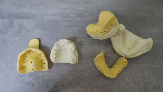 Second Impression Trays — Batehaven, NSW — Keen Dentures