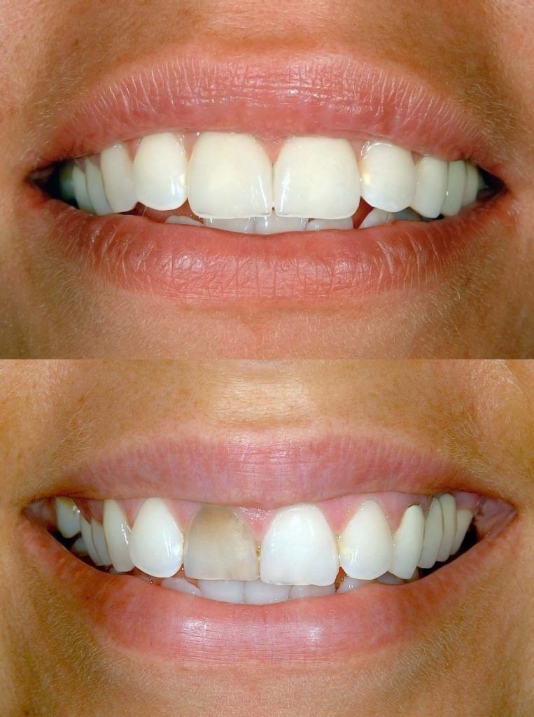 A before and after picture of a woman 's teeth.