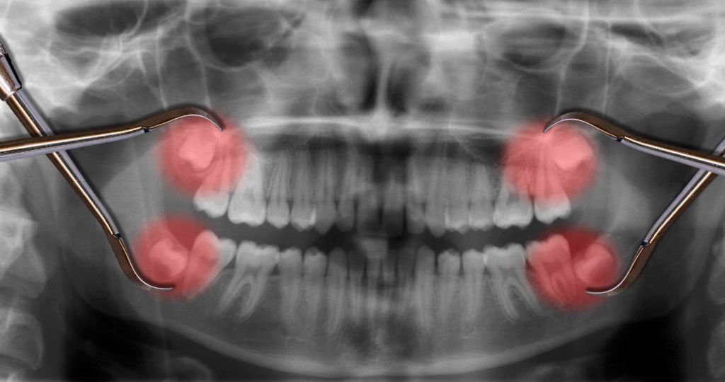 An x-ray of a person 's teeth with a pair of tweezers.