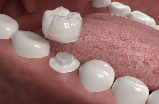 A close up of a person 's teeth with a dental crown.