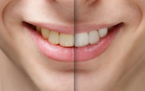 A before and after picture of a woman 's teeth.